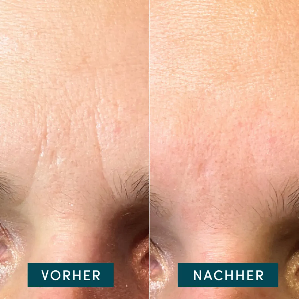 APRICOT Hautverjüngung|Gesicht^Facial Patches 100 Stück