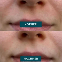 APRICOT Hautverjüngung|Gesicht^Mund Patches mit Panthenol 100 Stück