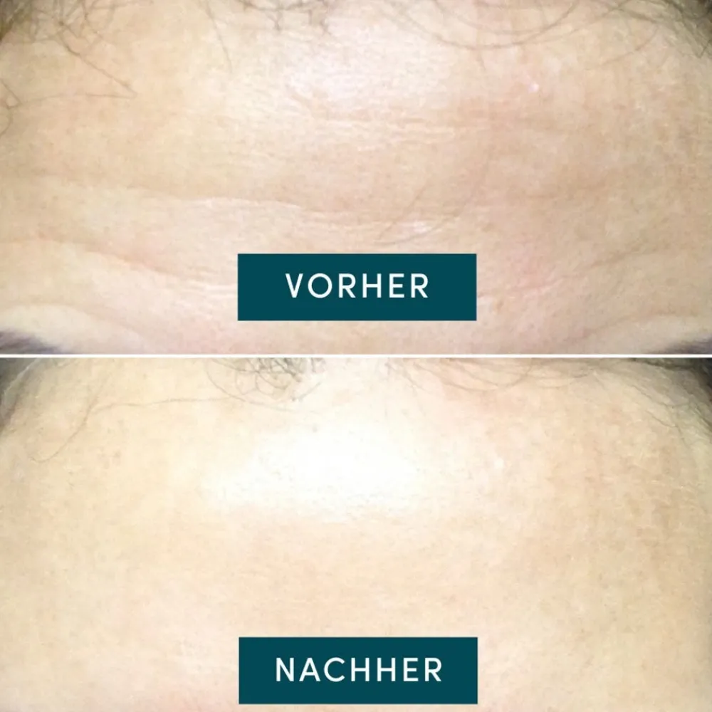 APRICOT Gesicht^Wiederverwendbares Stirn Pad mit Hyaluron