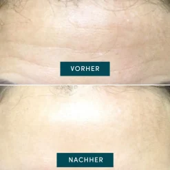 APRICOT Gesicht^Wiederverwendbares Stirn Pad mit Aloe Vera